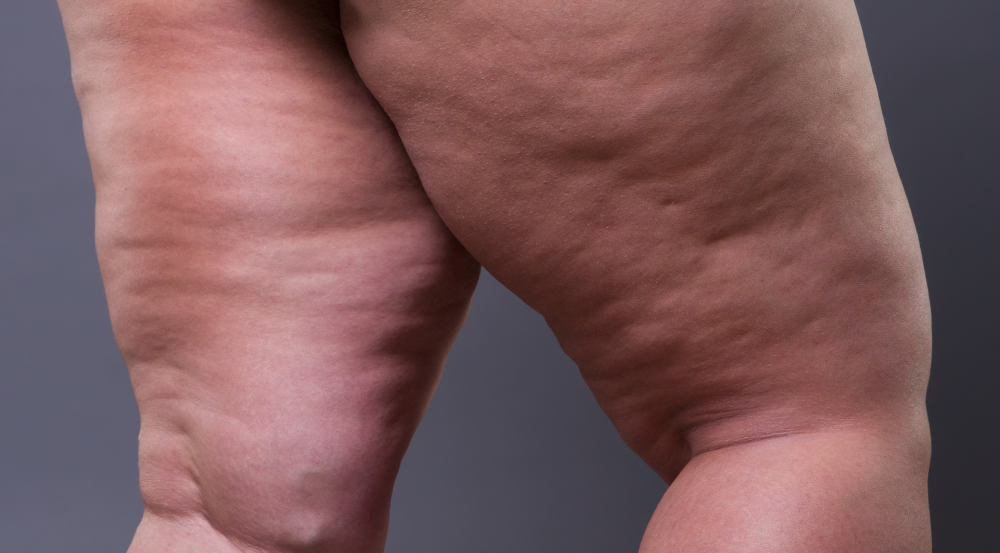 Lipedema: Gordura nas coxas e quadris